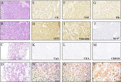 A refractory liver metastatic solid pseudopapillary neoplasm pancreas harbored CTNNB1 mutation showed good response to celecoxib: A case report